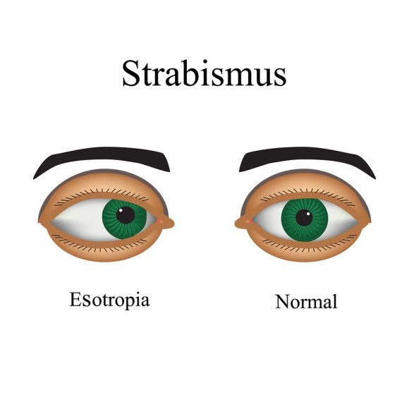 Strabismus